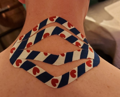 Tape trapezius